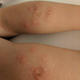 Picaduras en las piernas de la hija de 8 años de Heather Szilagyi. (Imagen: Heather Szilagyi / Twitter)